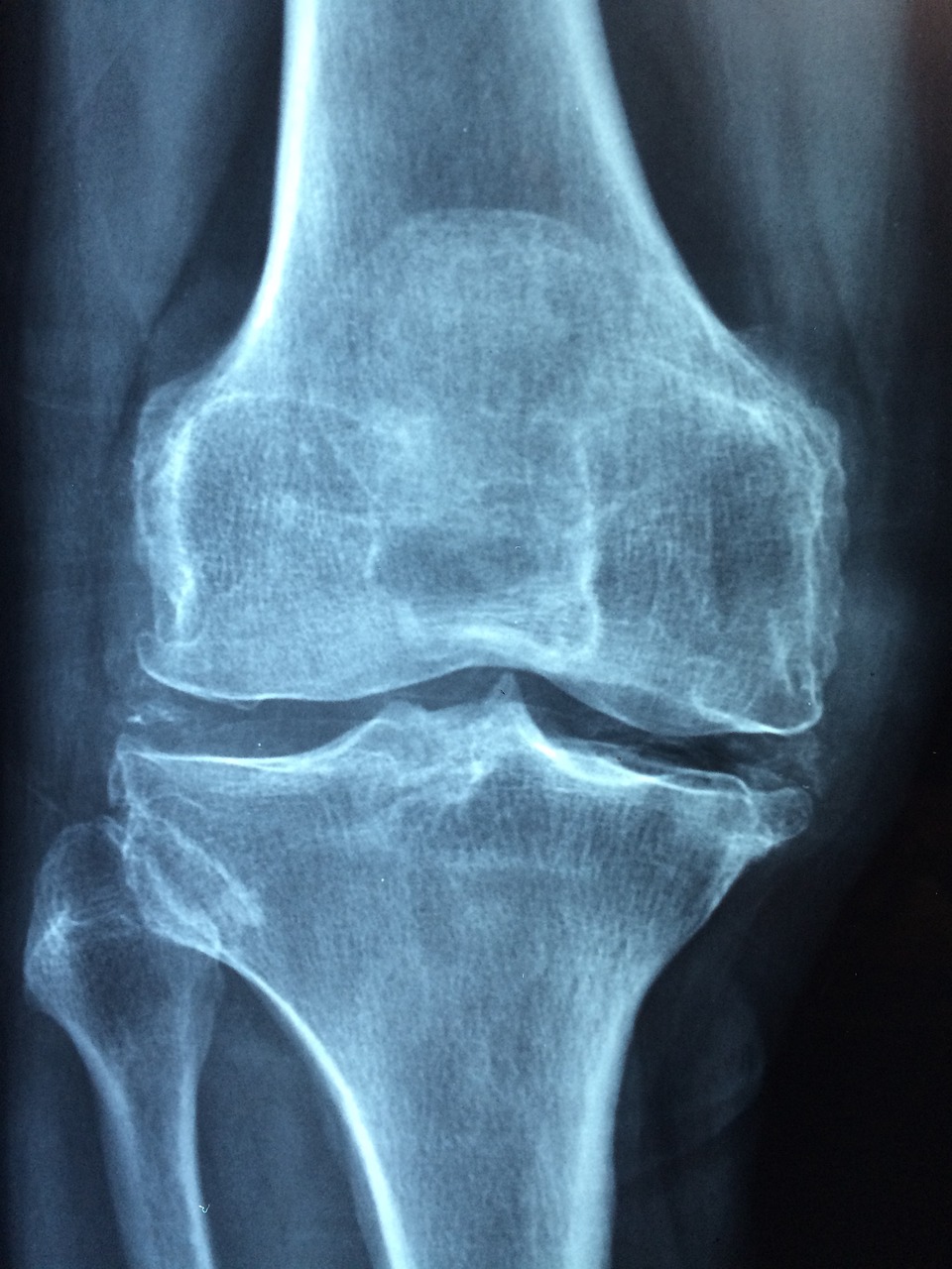 Ladies Merapat Yuk! 6 Tips Mencegah Osteoporosis pada Wanita