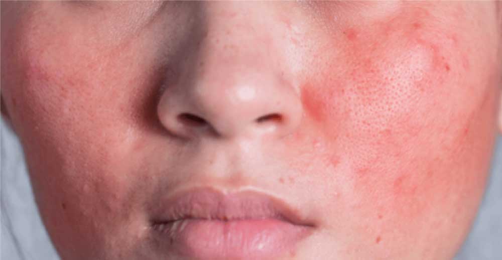 Kenali Ciri-ciri Skin Barrier Rusak, Ini Salah Satunya Penyebabnya