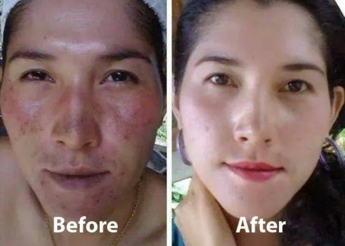 5 Bahan Skincare Untuk Menghilangkan Flek Hitam