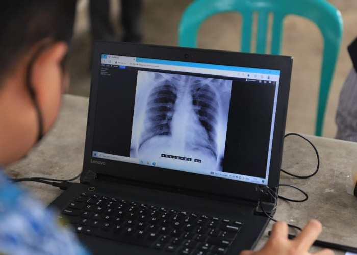 Skrining 13 Kecamatan, 51 Warga Benda Kota Tangerang Mengidap TBC