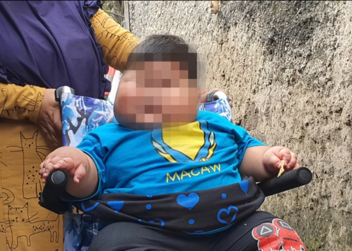 Kenzie Bayi Obesitas Dari Bekasi Kini Dalam Pengawasan Ketat Dokter Ahli RSCM, Daftar Makanan Harus Ditaati