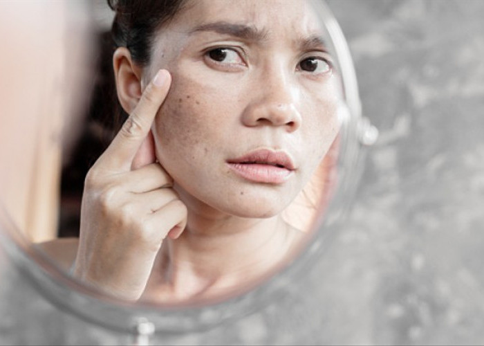 Atasi Flek Hitam di Wajah, Ini Rekomendasi Perawatan Skincare Kulit Terbaik yang Wajib Dicoba