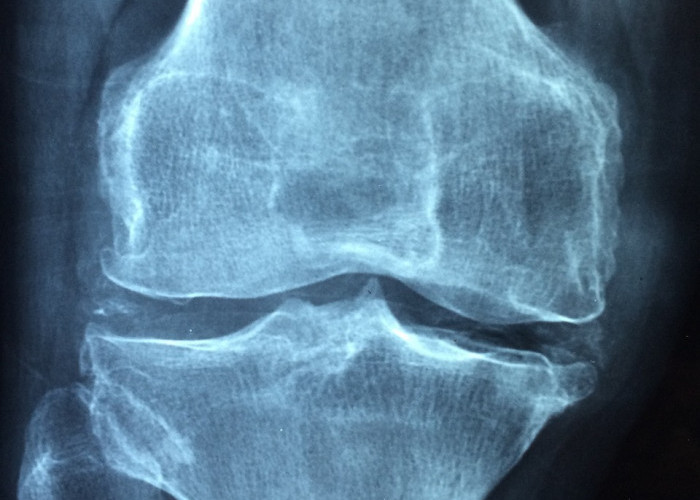 Ladies Merapat Yuk! 6 Tips Mencegah Osteoporosis pada Wanita