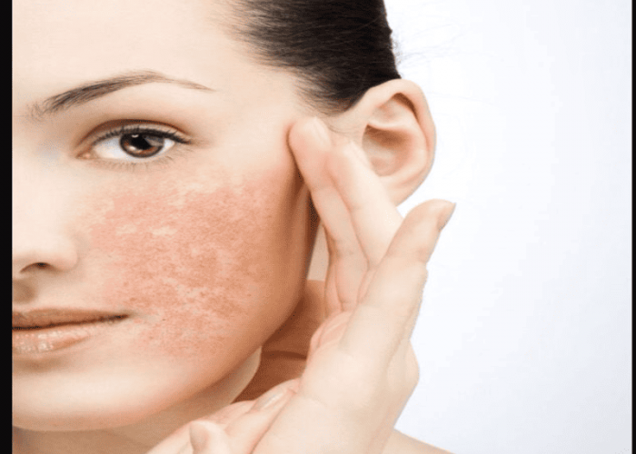 Gak Pede Punya Acne Prone Skin? Ini Cara Perawatan Tepat untuk Mengatasinya