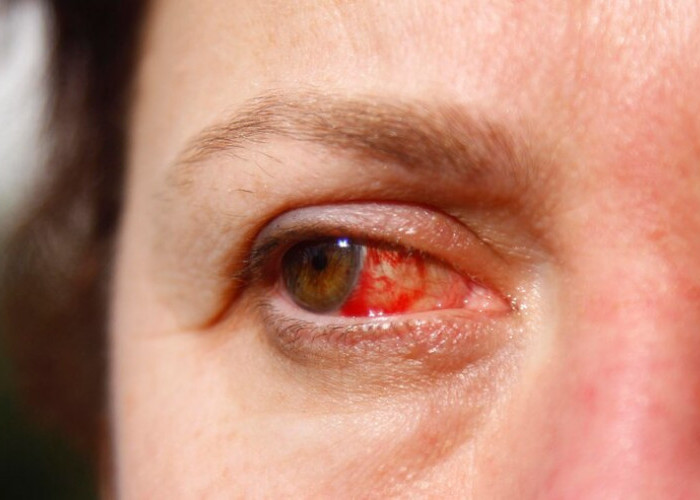 5 Penyebab Mata Merah yang Paling Umum dan Cara Meredakannya