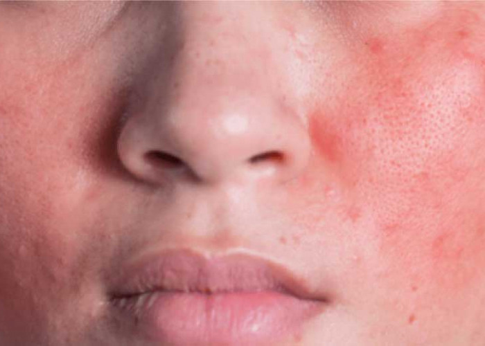 Kenali Ciri-ciri Skin Barrier Rusak, Ini Salah Satunya Penyebabnya